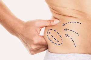 liposuzione liposuzione
