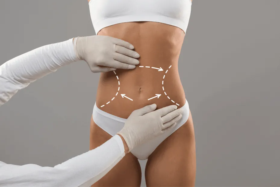 liposuzione medica