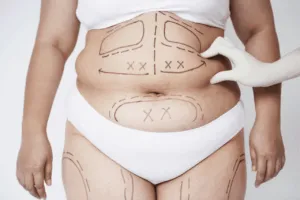 liposuzione quando farla liposuzione quando farla