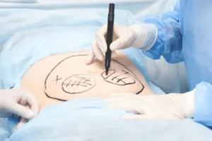 operazione liposuzione operazione liposuzione