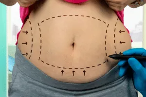 cos è la liposuzione cos è la liposuzione