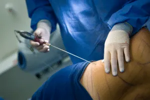 interventi di liposuzione interventi di liposuzione