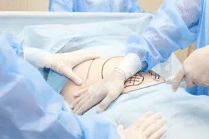 liposuzione intervento liposuzione intervento