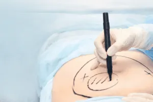 cos'è la liposuzione cos'è la liposuzione