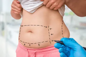 liposuzione chirurgica liposuzione chirurgica